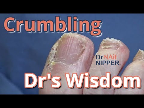 Crumbling, Doctor's Wisdom, Toenails, Callus, Arthritis. FEET-ure Friday. Dr Nail Nipper (2021) 1