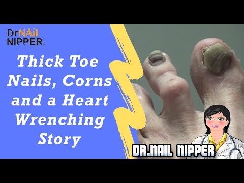 Thick Toenails, Foot Corns (Calluses) and Heart Wrenching Story 1