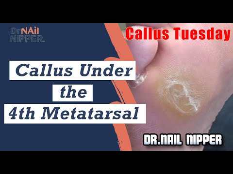 Callus Under the 4th Metatarsal. What is Neuropathy? [Callus Tuesday] (2020) 1