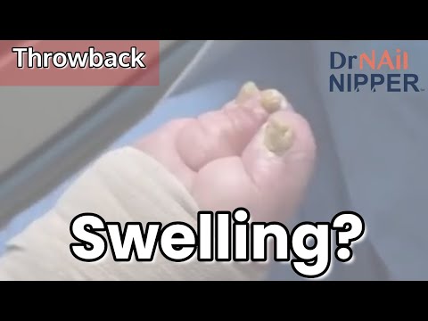 What are lymphedema symptoms? Swelling Feet and Lymphedema. [Thursday Throwback] 1