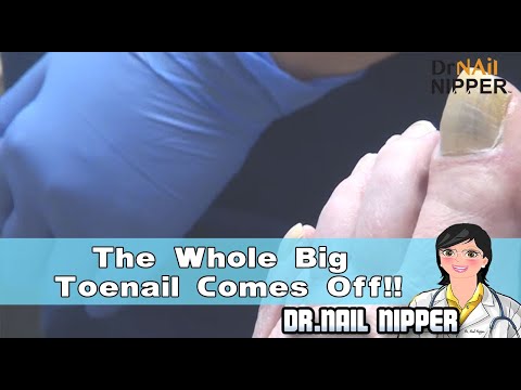 The Whole Big Toenail Comes Off!! Are you watching this video? 1