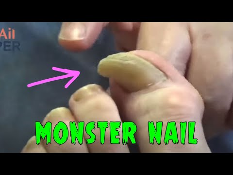 Patient Really Wants These Giant Nails Trimmed 1