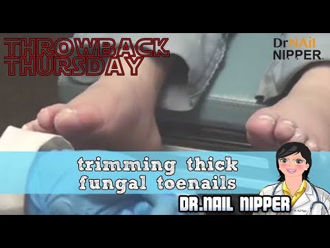 Trimming Thick Fungal Toenails #3 - Throwback Thursday 1