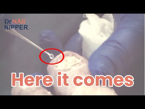 Throwback. Curette is King 1