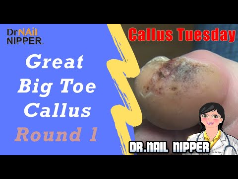 Great Big Toe Callus - Round 1 - #48 [Callus Tuesday] (2019) 1