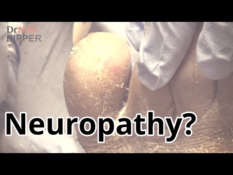 Neuropathy patient. FEETure Friday. (2021) 1