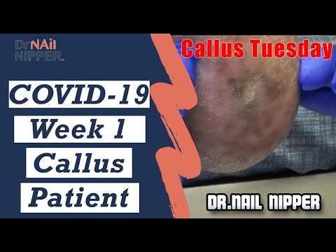 COVID-19 Week 1 Callus Tuesday (2020) 1