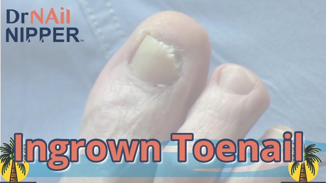 Ingrown Toenails [Throwback Thursday] 2