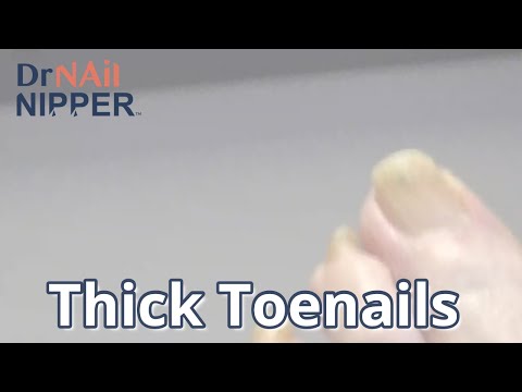 Thick Toenails and Dog Lover. FEET-ure Friday (2021) 1