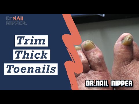 Hey sailor, how about we trim your thick toenails. Are thick toenails healthy? (2020) 1