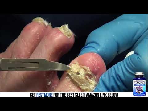 Spongy Toenails and Feet - 2 of 2 1