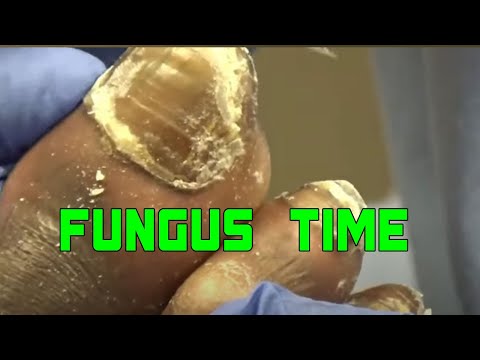 Extreme Thick Fungal Nails 1