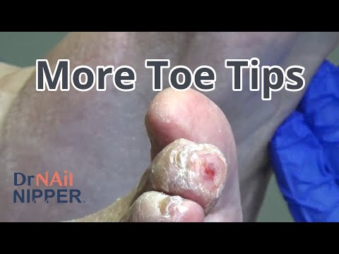 Toenails and Thick Toe Corns (2021) 1