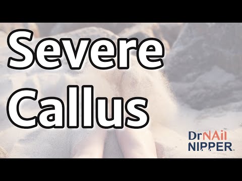 Callus Tuesday. Severe Callus. Long Version (2021) 1