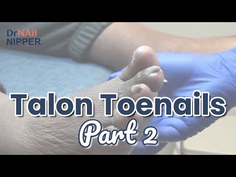 Talon Toenails - Throwback 1