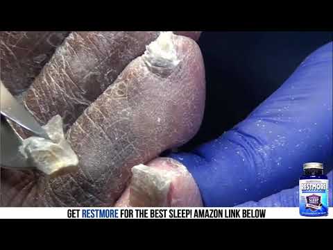 Spongy Toenails and Feet - 1 of 2 1