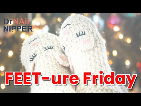 Severe Calluses. Part 1. FEET-ure Friday (2021) 1