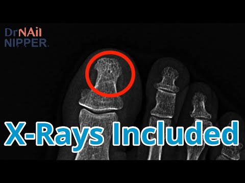 Painful, Bruised Toenail with Old Fracture 1