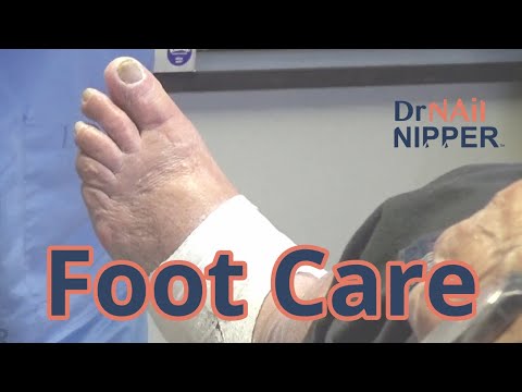 Diabetic Toenail Care. FEET-ure Friday (2021) 1