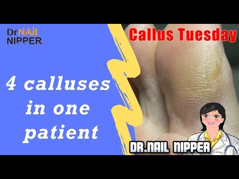 What causes foot callus? Four Calluses in One Patient - Callus Tuesday #45 1