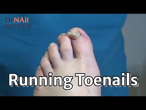 Runners and Toenails Throwback 1