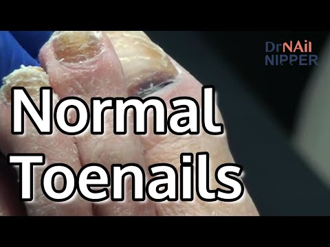 NOT Thick or Big Toenails. FEET-ure Friday (2022) 1