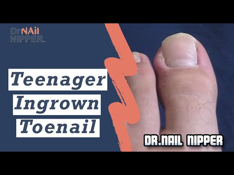 Teenager Ingrown Toenail (2019) 1