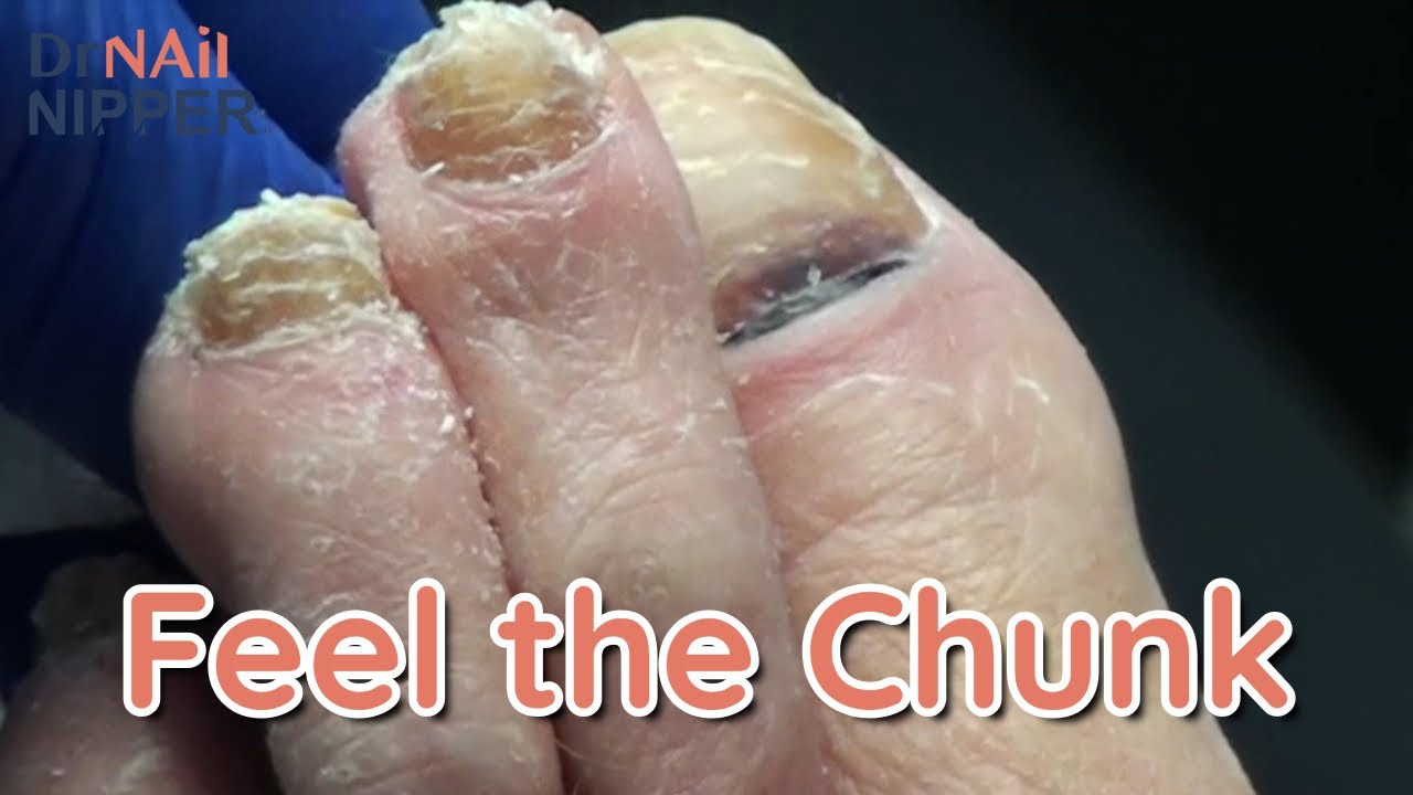 Toenail chunks. Chunks and Gunk #14 with Conversation (2022) 1