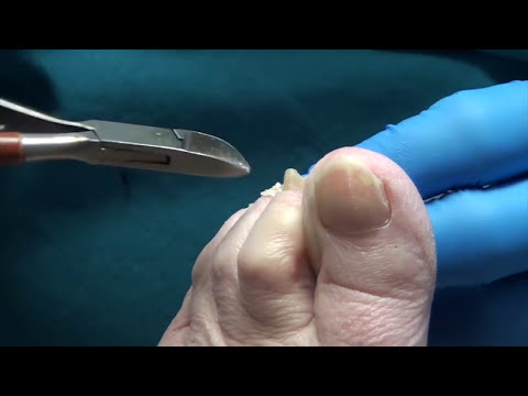 How to Trim Thick Diabetic Nails? Painful Calluses for the Patient 1