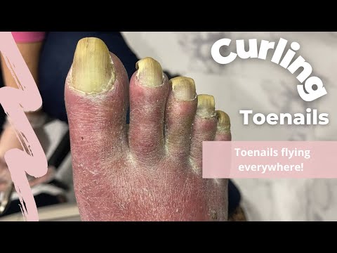 Curling Toenails 1