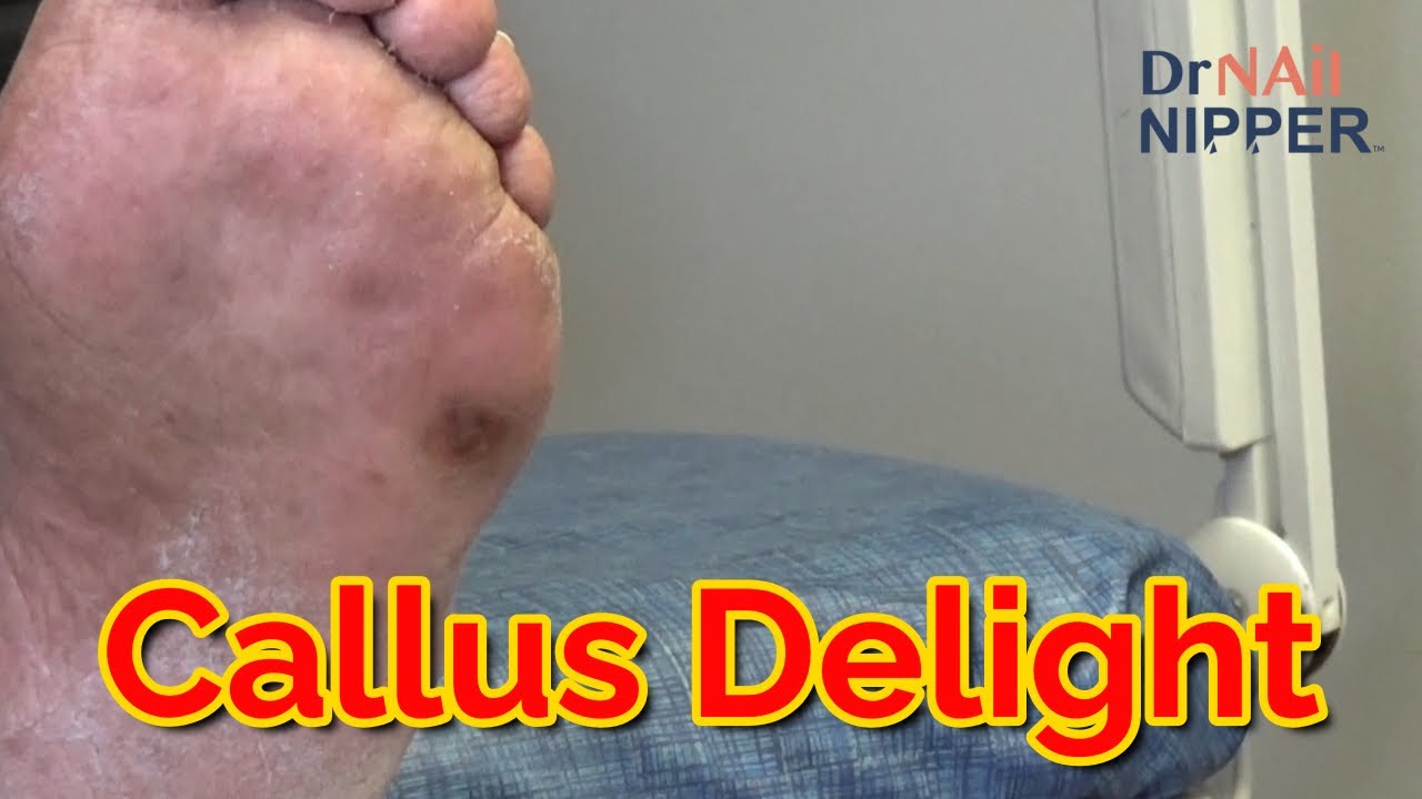3 Minutes of Callus Delight (2022) 1