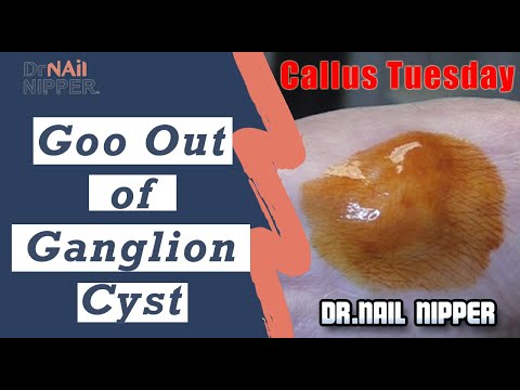 What is a Ganglion Cyst? How to treat ganglion cyst? (2019) 1