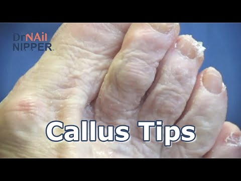 Callus on Toe Tips. FEET-ure Friday (2022) 1