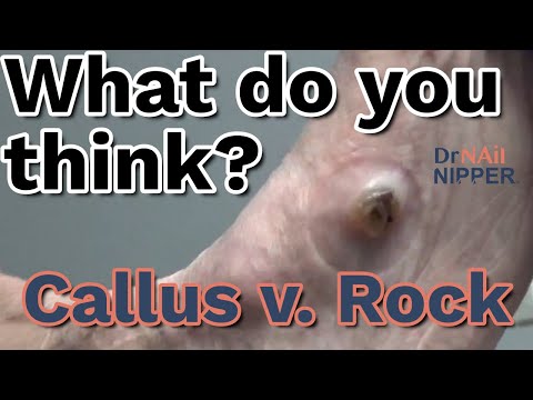 Callus or Rock? Ankle Foot Orthosis Support. Callus Tuesday (on a Wednesday) - Is Back? (2022) 1