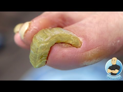TRIMMING SUPER THICK & HARD TO CUT TOENAILS ***HOW TO TREAT DEFORMED TOENAILS*** 1