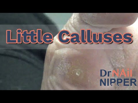 Little Calluses. Callus Tuesday (2022) 1