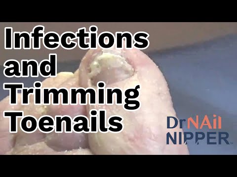 Trimming Toenails and Discussing Infections. FEET-ure Friday (2022) 1