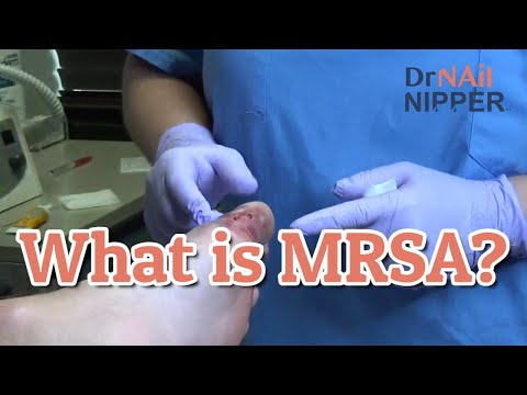 Toe Infection with MRSA. What is MSRA? (2022) 1