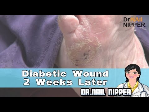 Diabetic Wound 2 Weeks Later 1 Diabetic Wound 2 Weeks Later 1