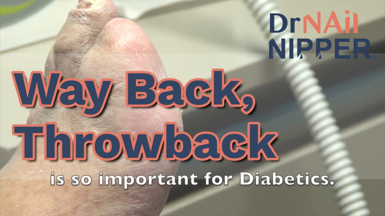 Throwback - Way Back - Really Thick Toenails 3