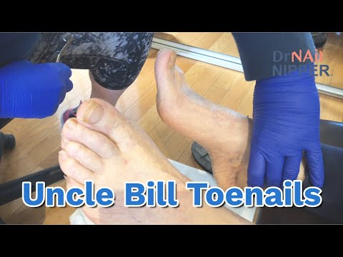 Dr Nail Nipper in California. Family Uncle Bill. Toenails (2022) 1