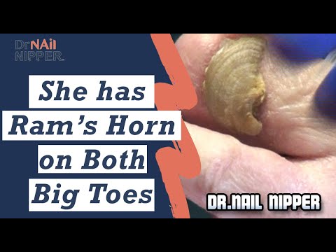 She Has Ram's Horn Nails on Both Big Toes (2020) 1