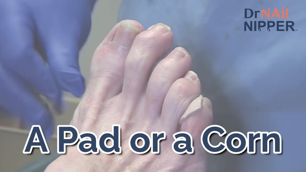 Corn Removal Throwback - Fix a Corn, Have a Pad and Dr Nail Nipper 6