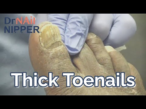 No Thick Toenails Here... Keep Moving (2022) 1