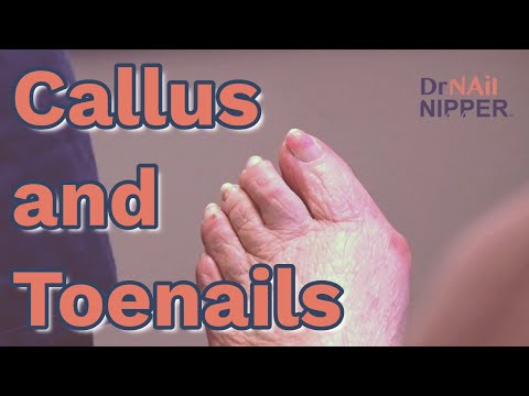 Callus and Toenails. FEET-ure Friday (2022) 1