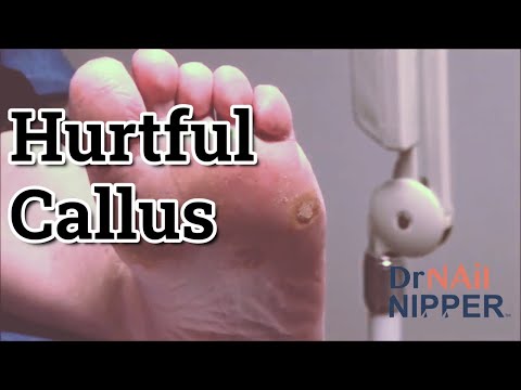 Throwback - Painful Callus 1