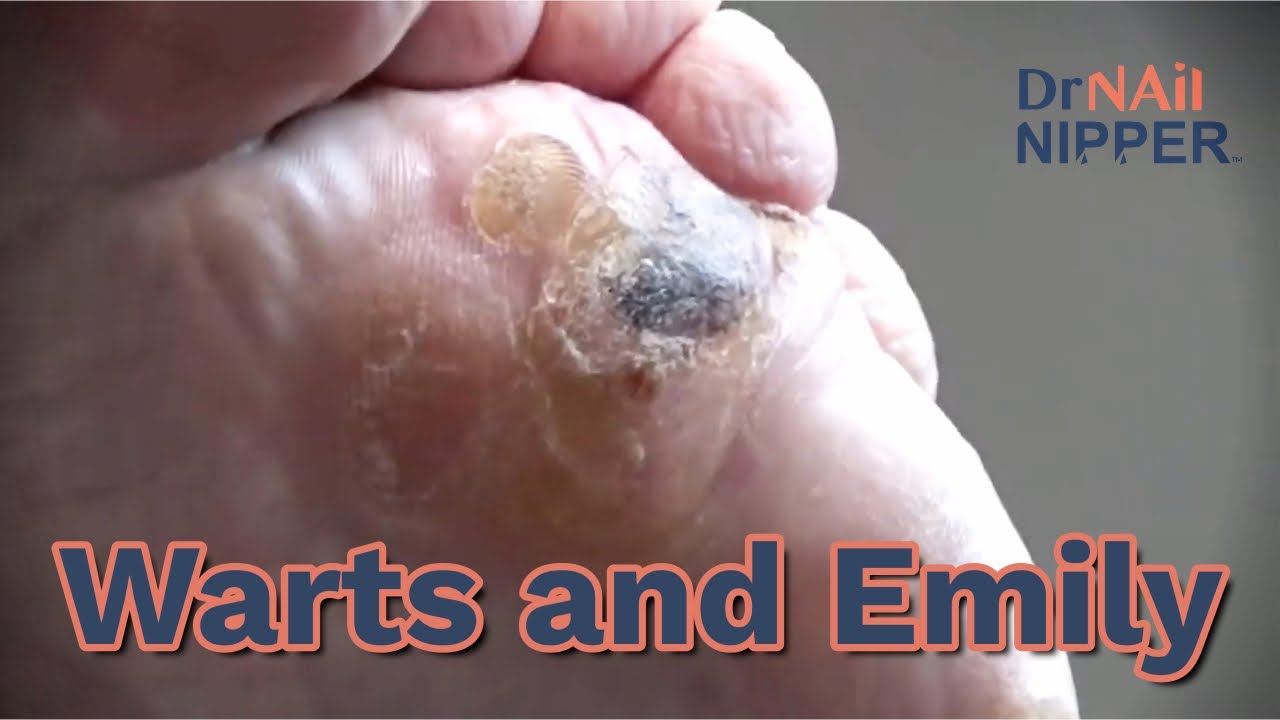 Throwback - Warts with Emily 1