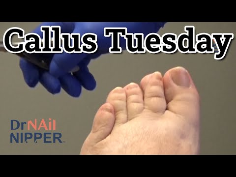 Callus Tuesday - Interesting Callus (2022) 1