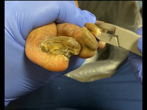 Hard MYCOTIC thick nails debridement 1