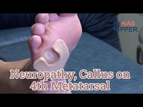 Throwback - What is Neuropathy? 4th Metatarsal with Callus 1